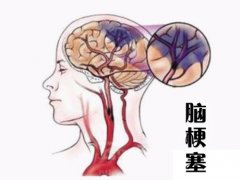 養(yǎng)成好的生活習(xí)慣，能夠有效預(yù)防腦梗塞